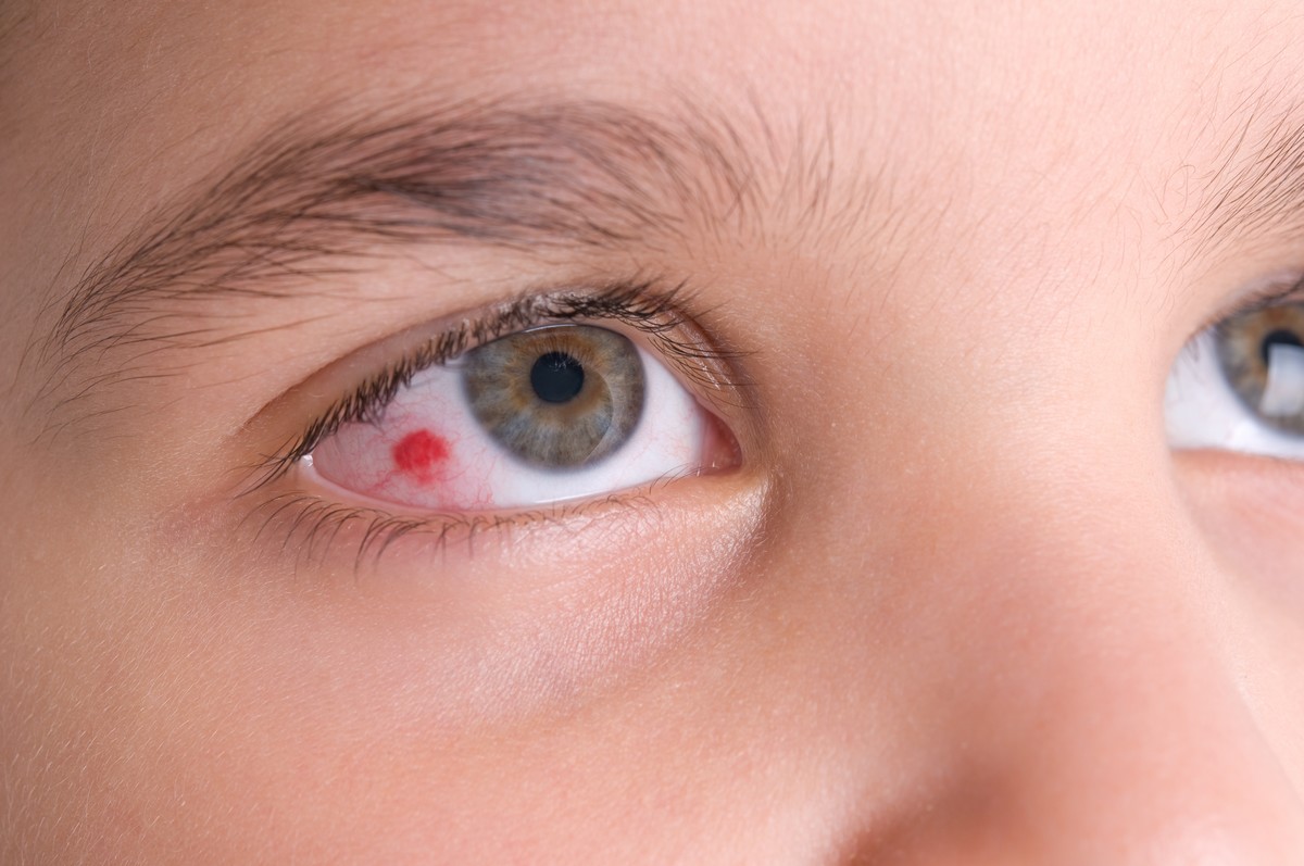 Capillaire cassé dans l'œil : Causes et remèdes