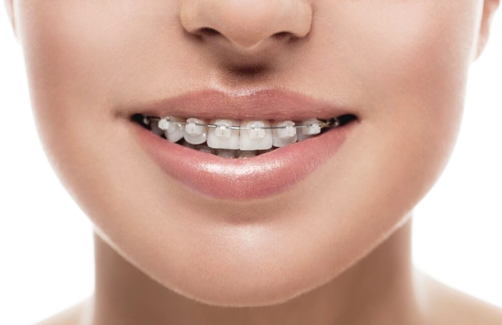 Orthodontie pour adultes : quelles techniques, quel coût ? prix pas cher