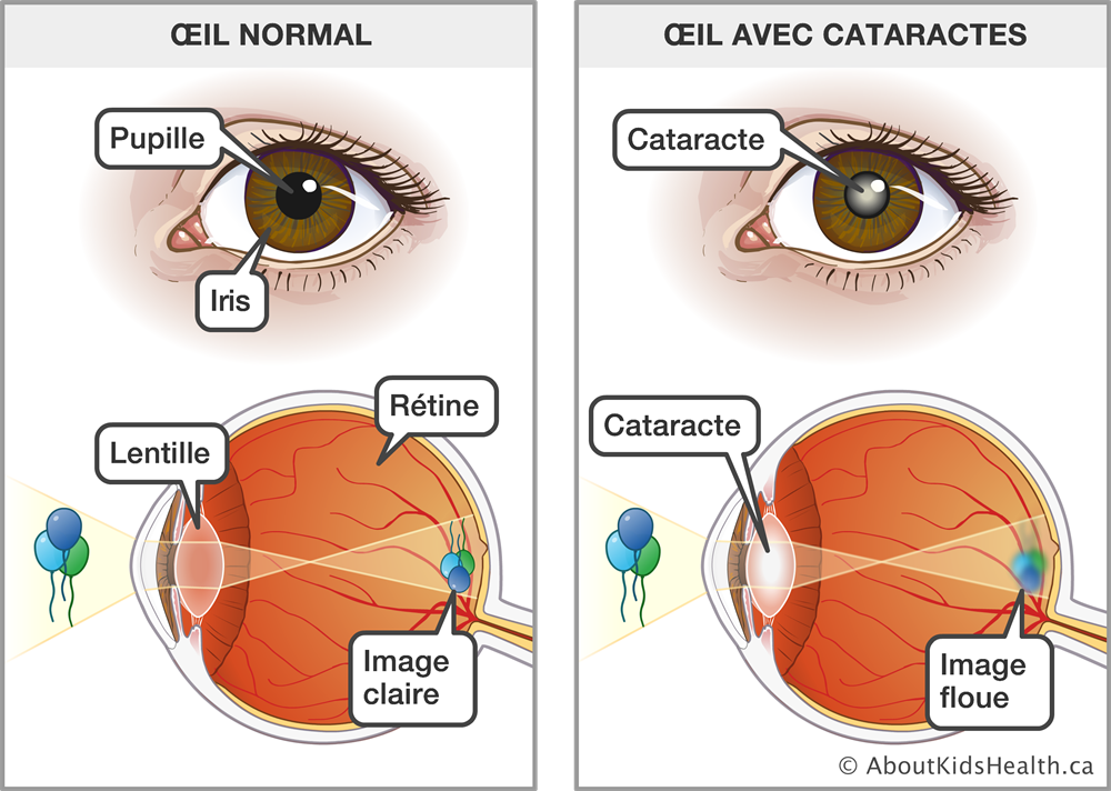 cataract-v2-med-ill-fr_5f5660b9726ab.jpg